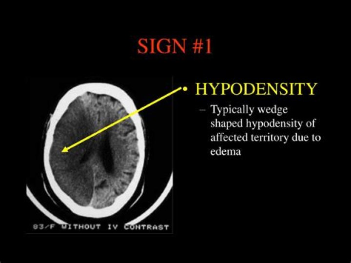 what does hypodensity mean on a ct scan